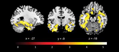 Large-Scale Functional Networks, Cognition and Brain Structures Supporting Social Cognition and Theory of Mind Performance in Prodromal to Mild Alzheimer’s Disease